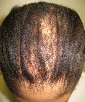 The Secret to Saving Your Receding Hairline in 2023 - Ywigs